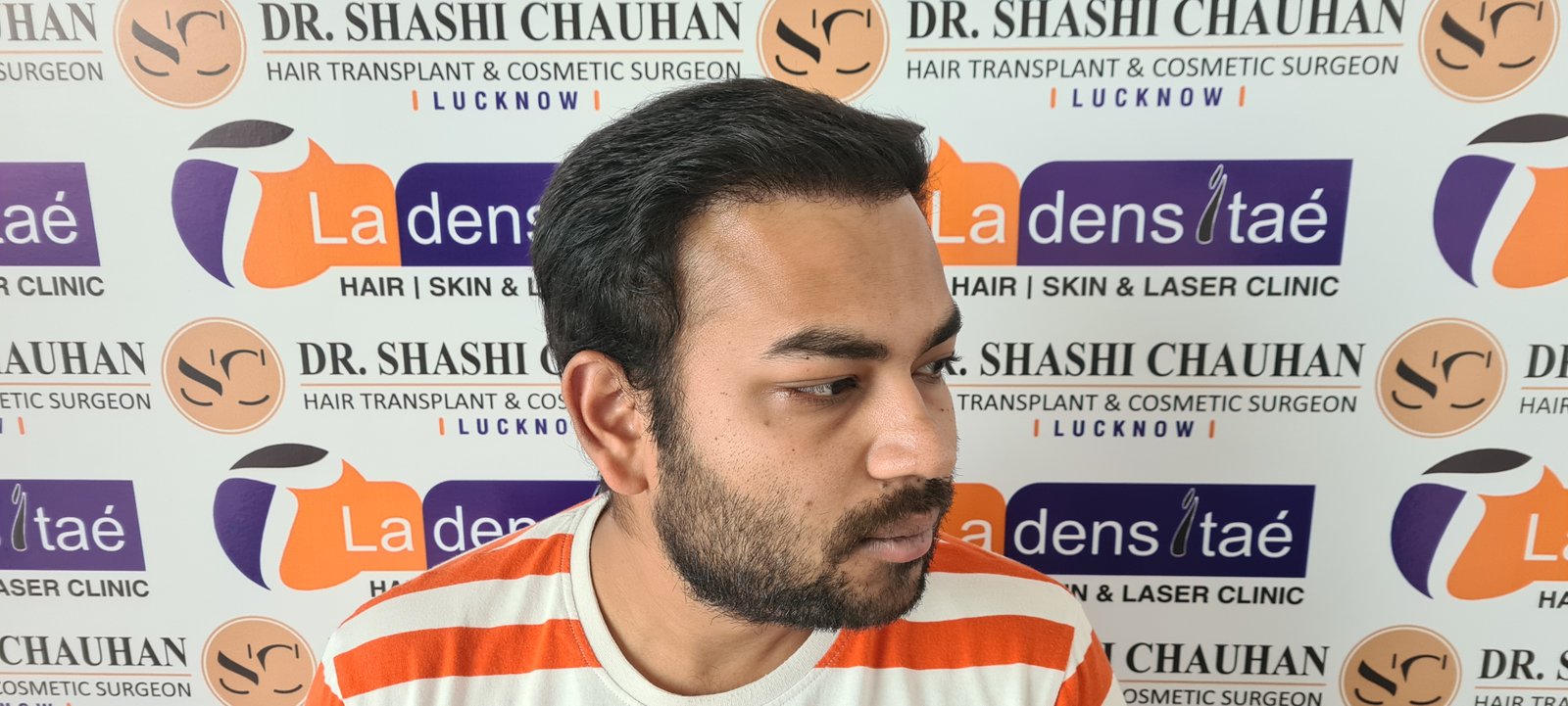 Arnav Dayal After Hair Transplant